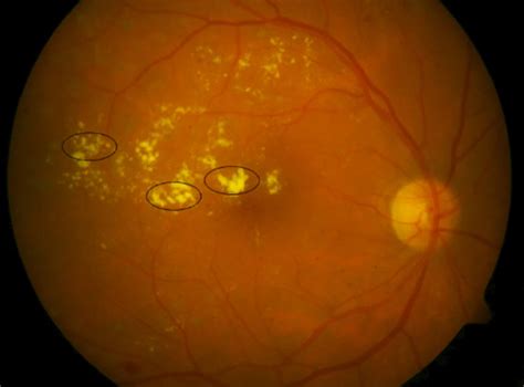 fundoscopy findings|Iba pa.